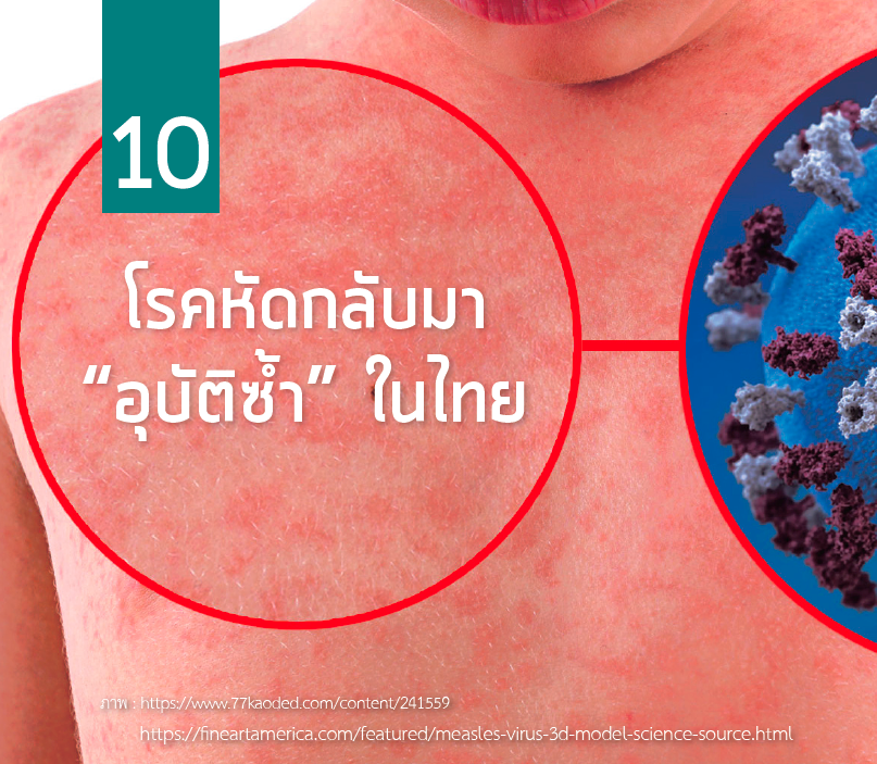  โรคหัดกลับมา “อุบัติซ้ำ” ในไทย