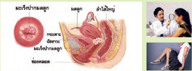 ทำอย่างไรสงครามปราบมะเร็งปากมดลูก จึงจะมาถูกทาง